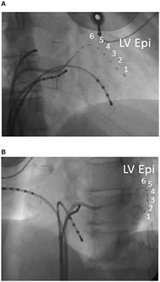 Local Left Ventricular Epicardial J Waves and Late Potentials in Brugada Syndrome Patients with Inferolateral Early Repolarization Pattern